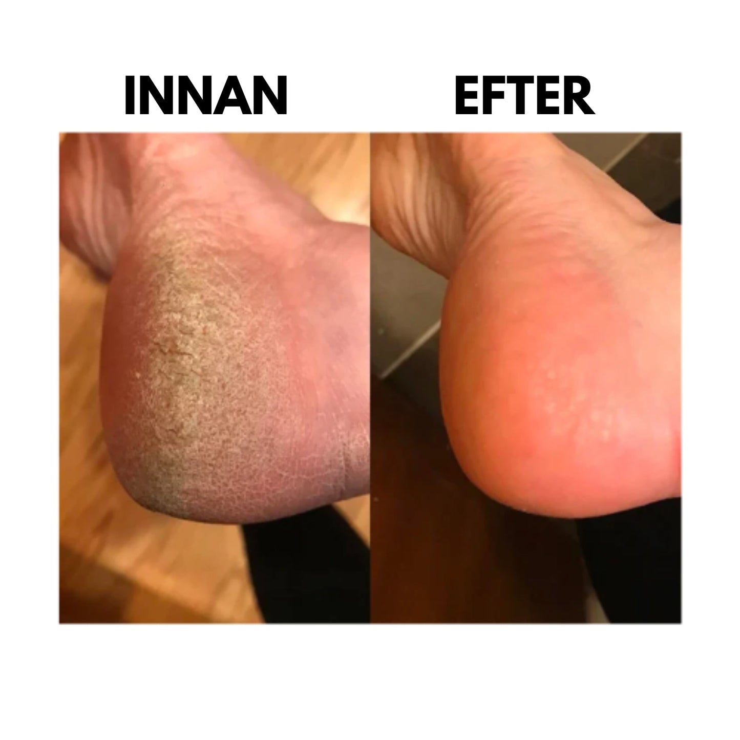 Dr. Svensson Fotvård™ - Fotskrap